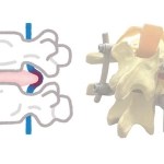 Bel Fıtığında Platin Kullanımı Gerekli mi?