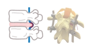 Bel Fıtığında Platin Kullanımı Gerekli mi?