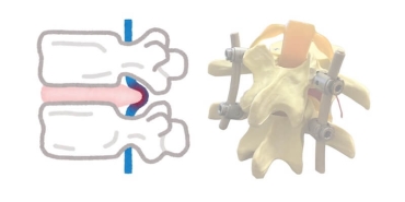 Bel Fıtığında Platin Kullanımı Gerekli mi?